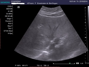 Pacientă asimptomatică clinic, se prezintă pentru un examen ultrasonografic de rutină. Explorarea efectuată prin secțiuni oblic subcostale, intercostale, coronale și sagitale în hipocondrul și flancul drept, pune în evidență în contact cu diafragmul, în s. VIII, antero-superior și medial, lobul drept, o imagine nodulară hepatică de consistență parenchimatoasă, neomogenă, hiperecogenă, avasculară, bine delimitată la periferie, prezentând un gabarit mediu (volulum de aproximativ 140 cmc). Tumora intră în contact intim cu traiectele venelor hepatice medie și dreaptă, în locul de abușare al acestora în vena cavă inferioară. Sistemul venos amprentat de către tumoră este permeabil. Diagnosticul prezumtiv ecografic este de ANGIOM CAVERNOS HEPATIC, diagnstic confirmat ulterior prin ultrasonografia cu substanță de contrast și prin ex. CT. Markerii hepatici și transaminazele încadrabile în normalitate. Arhivă personală 2011-2014; București; șoseaua Pantelimon 302, sectorul 2; publicat de Bot Eugen 04.11.2014; 20:21