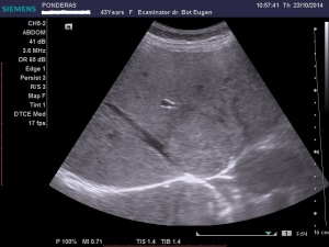 Pacientă asimptomatică clinic, se prezintă pentru un examen ultrasonografic de rutină. Explorarea efectuată prin secțiuni oblic subcostale, intercostale, coronale și sagitale în hipocondrul și flancul drept, pune în evidență în contact cu diafragmul, în s. VIII, antero-superior și medial, lobul drept, o imagine nodulară hepatică de consistență parenchimatoasă, neomogenă, hiperecogenă, avasculară, bine delimitată la periferie, prezentând un gabarit mediu (volulum de aproximativ 140 cmc). Tumora intră în contact intim cu traiectele venelor hepatice medie și dreaptă, în locul de abușare al acestora în vena cavă inferioară. Sistemul venos amprentat de către tumoră este permeabil. Diagnosticul prezumtiv ecografic este de ANGIOM CAVERNOS HEPATIC, diagnstic confirmat ulterior prin ultrasonografia cu substanță de contrast și prin ex. CT. Markerii hepatici și transaminazele încadrabile în normalitate. Arhivă personală 2011-2014; București; șoseaua Pantelimon 302, sectorul 2; publicat de Bot Eugen 04.11.2014; 20:26