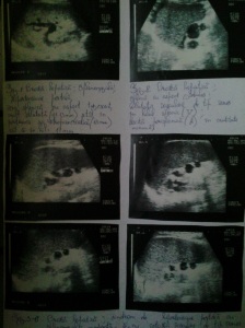 Despre cum splenomegalia consună cu ultrasunetele în cadrul sindromului de hipertensiune portală; Splenomegalie congestivă; Ciroză hepatica de etiologie virală C; Sindrom de hipertensiune portală; ectazii venoase perisplenice; Circulație colaterală perisplenică și interspleno-renală; Ecografie în scară gri; Arhivă personală ; 2004-2008; fotografiile mele; ultrasonografie; publicat de Bot Eugen. șoseaua Pantelimon 302; sectorul 2; București; 04.05.2015; 18:04