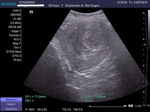 Fibroamele uterine. Leiomiomul (IV); Uter fibromatos; Fibrom uterin cu dezvoltare endocavitară; Fibrom uterin subseros boselând conturul posterior; fibroame uterine izoecogene/slab hipoecogene; fibroame uterine cu degenerescență edematoasă; DIU deplasat, cu poziție joasă, angajat în istmul și colul uterin; Ecografie în scară gri; Ecografie Doppler codificată color; Ecografie Doppler codificată spectral; Ecografie Doppler power; Ultrasonografie; Fotografiile mele; Arhivă personală 2004-2015; publicat de Bot Eugen. șoseaua Pantelimon 302; sectorul 2; București. 26.07.2015; 15:21