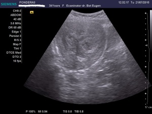 Fibroamele uterine. Leiomiomul (IV); Uter fibromatos; Fibrom uterin cu dezvoltare endocavitară; Fibrom uterin subseros boselând conturul posterior; fibroame uterine izoecogene/slab hipoecogene; fibroame uterine cu degenerescență edematoasă; DIU deplasat, cu poziție joasă, angajat în istmul și colul uterin; Ecografie în scară gri; Ecografie Doppler codificată color; Ecografie Doppler codificată spectral; Ecografie Doppler power; Ultrasonografie; Fotografiile mele; Arhivă personală 2004-2015; publicat de Bot Eugen. șoseaua Pantelimon 302; sectorul 2; București. 26.07.2015; 15:24