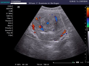 Fibroamele uterine. Leiomiomul (IV); Uter fibromatos; Fibrom uterin cu dezvoltare endocavitară; Fibrom uterin subseros boselând conturul posterior; fibroame uterine izoecogene/slab hipoecogene; fibroame uterine cu degenerescență edematoasă; DIU deplasat, cu poziție joasă, angajat în istmul și colul uterin; Ecografie în scară gri; Ecografie Doppler codificată color; Ecografie Doppler codificată spectral; Ecografie Doppler power; Ultrasonografie; Fotografiile mele; Arhivă personală 2004-2015; publicat de Bot Eugen. șoseaua Pantelimon 302; sectorul 2; București. 26.07.2015; 15:27
