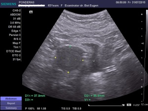 Uter fibromatos în involuție, latero-deviat înspre stânga; Fibroame interstițiale izoecogene/slab hiperecogene; Fibrom uterin interstițial izoecogen, delimitat printr-un inel hiperecogen; Fibrom pediculat latero-uterin drept; Fibrom pediculat latero-uterin drept deformând/apăsând pe peretele vezical lateral stâng; Ecografie în scară gri; Ultrasonografie; Fotografiile mele; Arhivă personală 2004-2015; publicat de Bot Eugen. șoseaua Pantelimon 302; sectorul 2; București. 31.07.2015; 22:28
