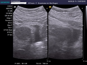 Uter fibromatos în involuție, latero-deviat înspre stânga; Fibroame interstițiale izoecogene/slab hiperecogene; Fibrom uterin interstițial izoecogen, delimitat printr-un inel hiperecogen; Fibrom pediculat latero-uterin drept; Fibrom pediculat latero-uterin drept deformând/apăsând pe peretele vezical lateral stâng; Ecografie în scară gri; Ultrasonografie; Fotografiile mele; Arhivă personală 2004-2015; publicat de Bot Eugen. șoseaua Pantelimon 302; sectorul 2; București. 31.07.2015; 22:28