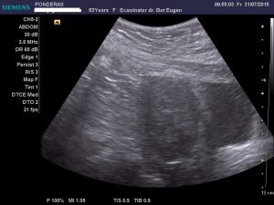 Uter fibromatos în involuție, latero-deviat înspre stânga; Fibroame interstițiale izoecogene/slab hiperecogene; Fibrom uterin interstițial izoecogen, delimitat printr-un inel hiperecogen; Fibrom pediculat latero-uterin drept; Fibrom pediculat latero-uterin drept deformând/apăsând pe peretele vezical lateral stâng; Ecografie în scară gri; Ultrasonografie; Fotografiile mele; Arhivă personală 2004-2015; publicat de Bot Eugen. șoseaua Pantelimon 302; sectorul 2; București. 31.07.2015; 22:34