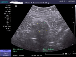 Uter fibromatos în involuție, latero-deviat înspre stânga; Fibroame interstițiale izoecogene/slab hiperecogene; Fibrom uterin interstițial izoecogen, delimitat printr-un inel hiperecogen; Fibrom pediculat latero-uterin drept; Fibrom pediculat latero-uterin drept deformând/apăsând pe peretele vezical lateral stâng; Ecografie în scară gri; Ultrasonografie; Fotografiile mele; Arhivă personală 2004-2015; publicat de Bot Eugen. șoseaua Pantelimon 302; sectorul 2; București. 31.07.2015; 22:34