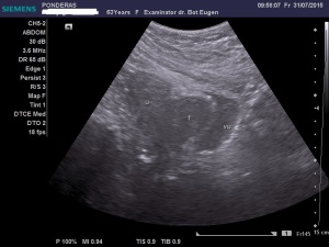 Uter fibromatos în involuție, latero-deviat înspre stânga; Fibroame interstițiale izoecogene/slab hiperecogene; Fibrom uterin interstițial izoecogen, delimitat printr-un inel hiperecogen; Fibrom pediculat latero-uterin drept; Fibrom pediculat latero-uterin drept deformând/apăsând pe peretele vezical lateral stâng; Ecografie în scară gri; Ultrasonografie; Fotografiile mele; Arhivă personală 2004-2015; publicat de Bot Eugen. șoseaua Pantelimon 302; sectorul 2; București. 31.07.2015; 22:38